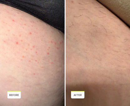 Auréa™ Smoothing Solution